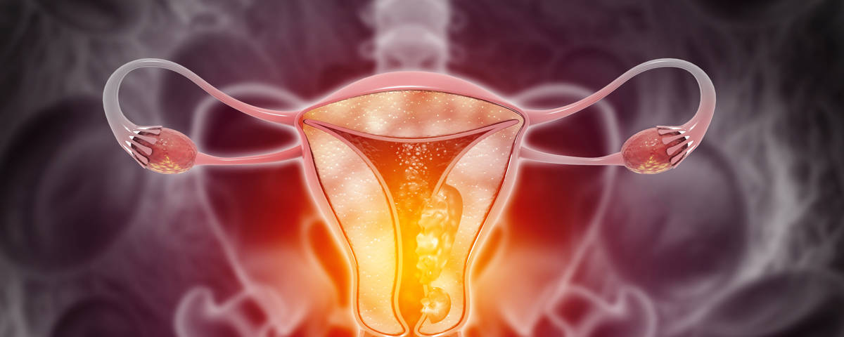 Endometriose PCOS_iStock-1344765494