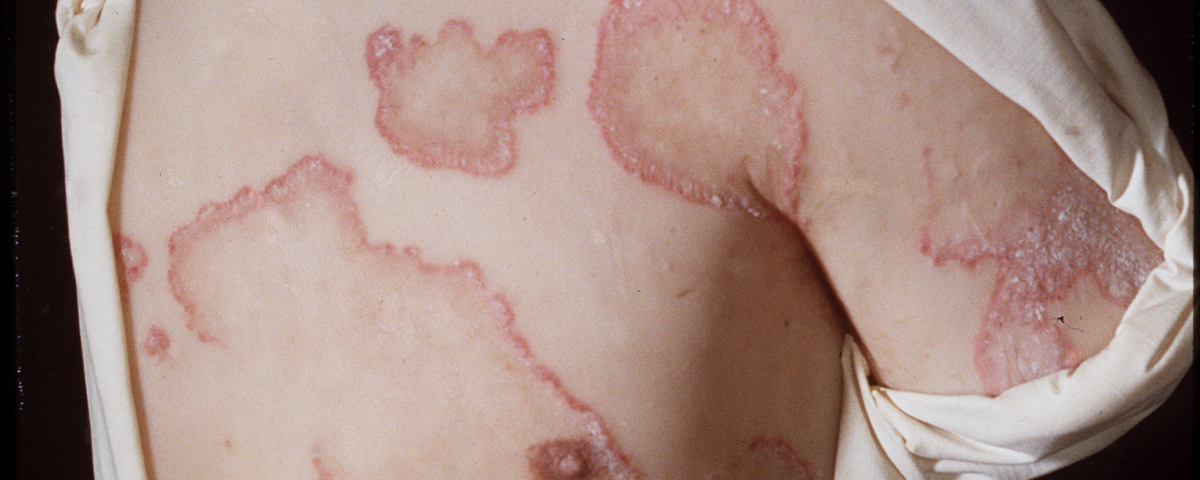Moulagenmuseum - Psoriasis 2